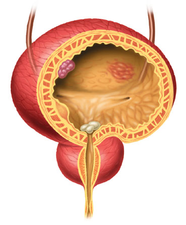 illustration for bladder disorder